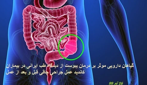 گیاهان دارویی موثر بر درمان یبوست از دیدگاه طب ایرانی در بیماران کاندید عمل جراحی چاقی قبل و بعد از عمل