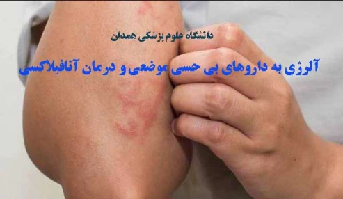 آلرژی به داروهای بی حسی موضعی و درمان آنافیلاکسی
