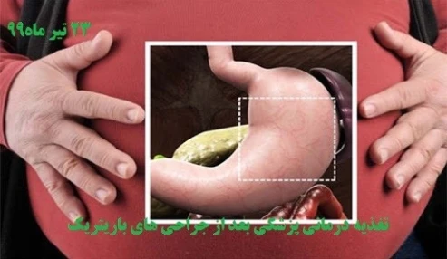 تغذیه درمانی پزشکی (MNT) بعد از جراحی باریتریک