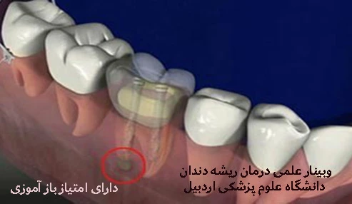 وبینار علمی  درمان ریشه دندان