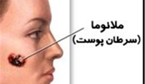 وبینار علمی  سرطان های پوست ملانومی