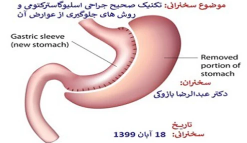 تکنیک صحیح اسلیو گاسترکتومی به روش لاپاراسکوپیک و روش های جلوگیری از عوارض عمل جراحی اسلیو