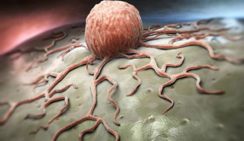 وبینار علمی  علائم ؛تشخیص و درمان cancer breast