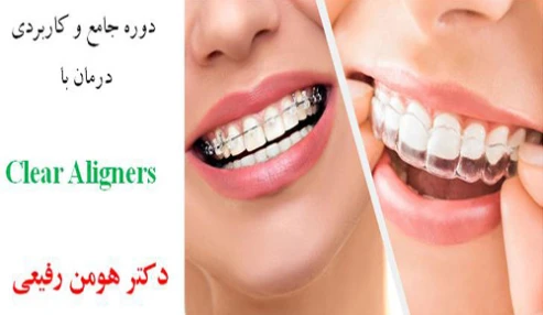 دوره کارگاهی و کاربردی Clear Aligners
