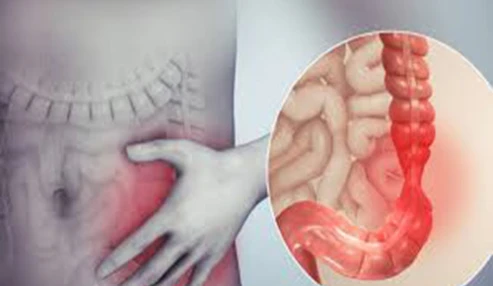 وبینار علمی  بیماری التهابی روده از دیدگاه طب ایرانی و طب رایج