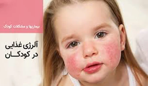 وبینار آلرژی غذایی درکودکان