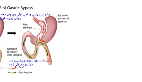 وبینار علمی  بررسی جراحی مینی بای پس معده به روش لاپاراسکوپیک( قسمت اول)