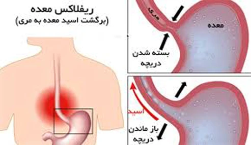 وبینار علمی بررسی اصول تشخیص و درمان بیماری ریفلاکس معده