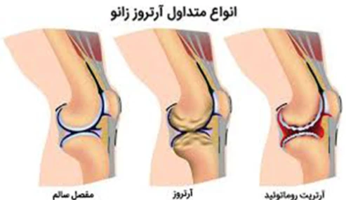وبینار علمی  نحوه برخورد و درمان غیر جراحی آرتروز زانو
