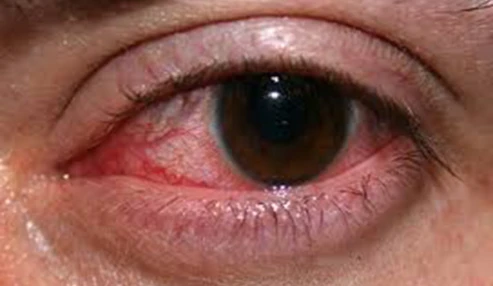 وبینار علمی  اورژانسهای چشم