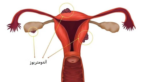 وبینار علمی  روش های درمانی آندومتریوز