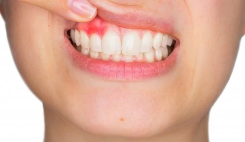 وبینار علمی  پوشش سطح ریشه، بازسازی و افزایش طول تاج دندان