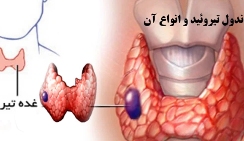 وبینار علمی  تیروئید