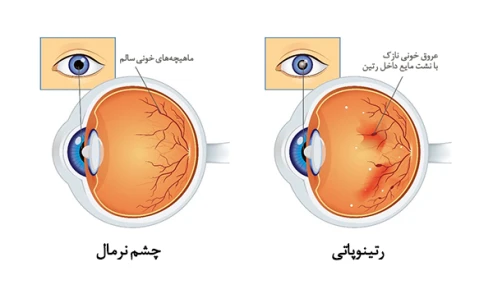 وبینار علمی نکات کاربردی در بیماری شایع رتین و کورویید