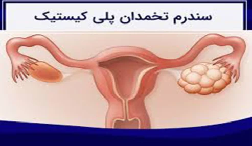 وبینار علمی  سندروم تخمدان پلی کیستیک و ناباروری