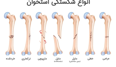 وبینار علمی  شکستگی استخوان نازال
