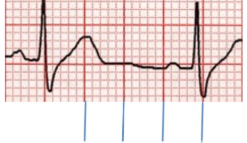 وبینار علمی  تفسیر ECG وآريتمي هاي شايع
